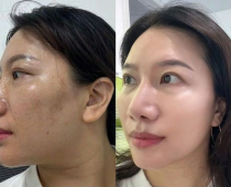 Vì Sao Nám Da Ngày Càng Đậm? Nguyên Nhân Nhiều Người Không Biết