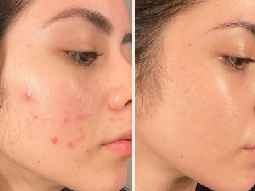 Cách Trị Mụn Tại Nhà Đúng Cách: Làm Gì Để Mụn Không Quay Lại?
