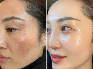 5 Sai Lầm Khi Điều Trị Nám Khiến Nám Mãi Không Khỏi