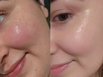 Dưỡng Sáng Da Mặt Nhanh - An Toàn - Hiệu Quả Với Chu Trình Chuẩn