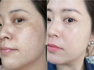 Cách Trị Nám Hiệu Quả Tại Nhà Được Nhiều Chị Em Áp Dụng Thành Công