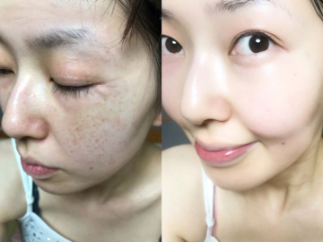 Kem Trị Nám Tốt Nhất Hiện Nay - Trị Nám The iLLON Có Hiệu Quả Không?