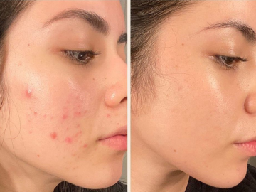 Cách Trị Vết Thâm Mụn Ở Mặt & Sẹo Mụn Tại Nhà Hiệu Quả 