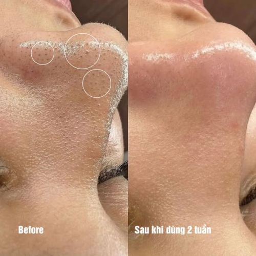 Mặt nạ peel sạch m:ụn đầu đen (Tặng 2 gói kem dưỡng The iLLON)