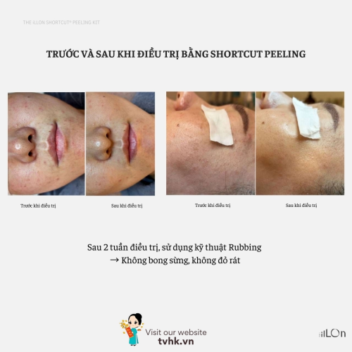 Peel Da Sinh Học THE iLLON Shortcut Peeling Kit