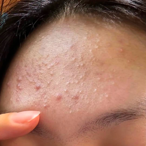 Murad Rapid Relief Acne Spot Treatment 15ml – Gel chấm mụn giảm sưng viêm nhanh chóng