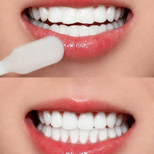 [SET 5 TUÝP] Kem đánh răng Crest 3D White Advanced Whitening – Set 5 tuýp 147g