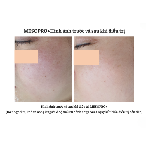 Bộ Sản Phẩm The ilLon Mesopro+Kit