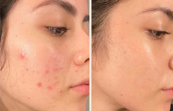 Cách Trị Mụn Tại Nhà Đúng Cách: Làm Gì Để Mụn Không Quay Lại?