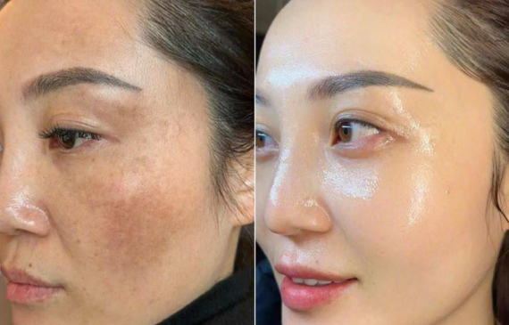 5 Sai Lầm Khi Điều Trị Nám Khiến Nám Mãi Không Khỏi