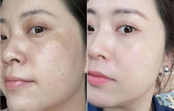 Cách Trị Nám Hiệu Quả Tại Nhà Được Nhiều Chị Em Áp Dụng Thành Công