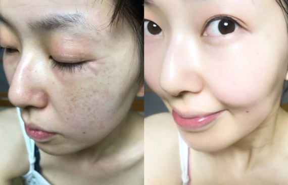 Kem Trị Nám Tốt Nhất Hiện Nay - Trị Nám The iLLON Có Hiệu Quả Không?