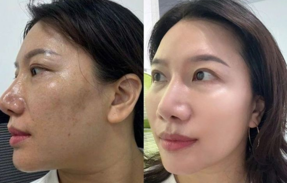 Vì Sao Nám Da Ngày Càng Đậm? Nguyên Nhân Nhiều Người Không Biết