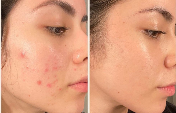 Cách Trị Vết Thâm Mụn Ở Mặt & Sẹo Mụn Tại Nhà Hiệu Quả 