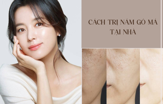7 Cách Trị Nám Gò Má Tại Nhà Hiệu Quả Không Phải Ai Cũng Biết