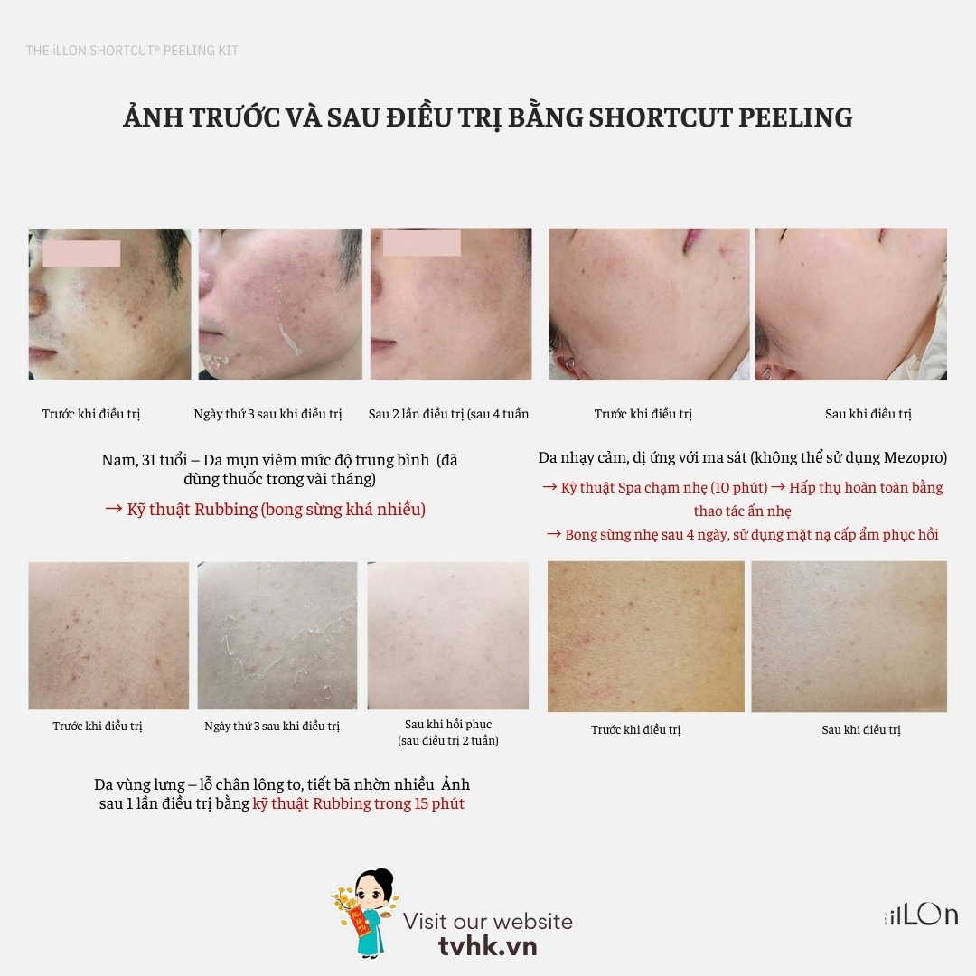 peel da tại nhà an toàn