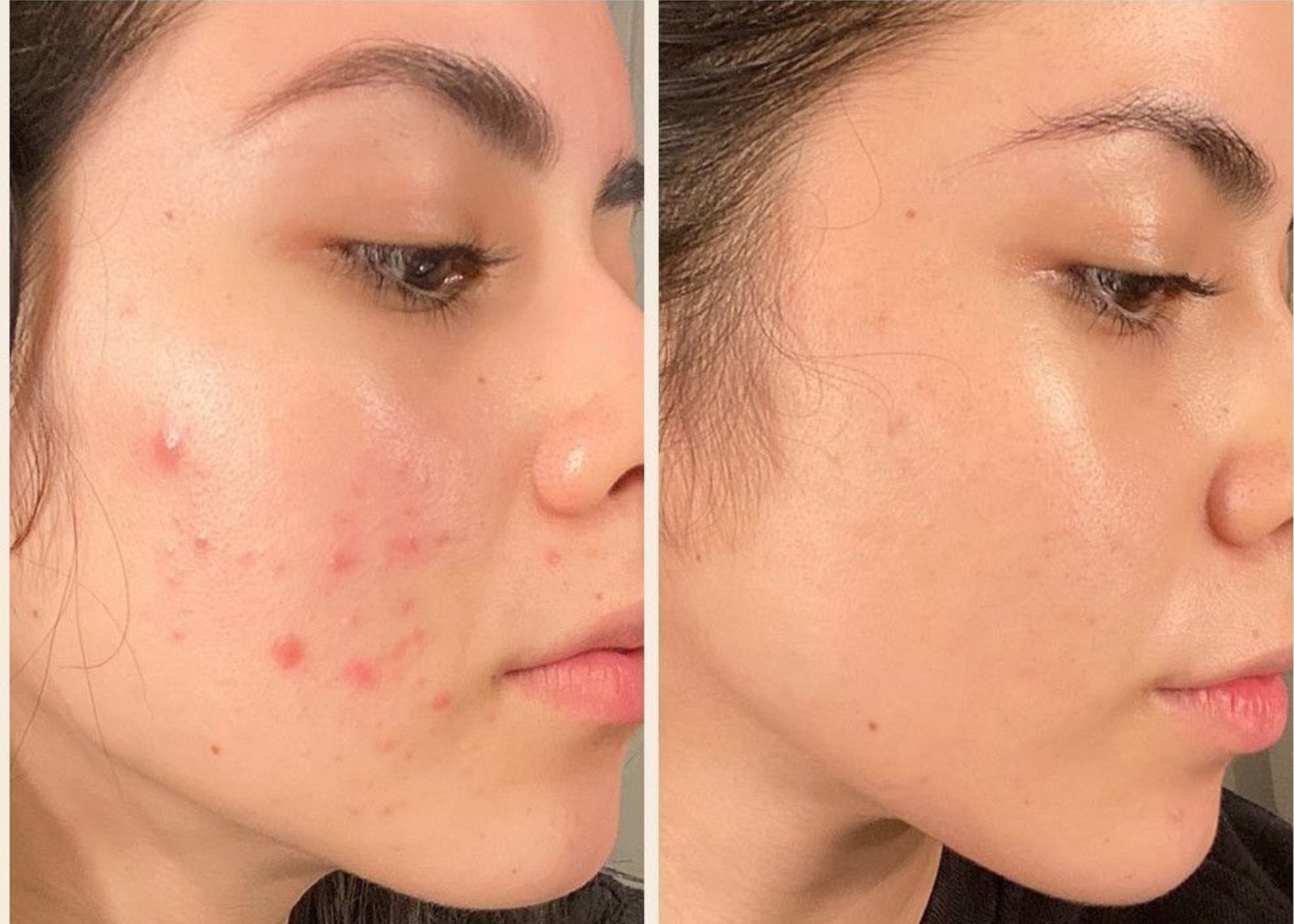 cách trị vết thâm mụn ở mặt