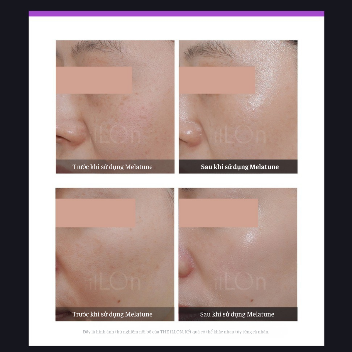 liệu trình peel mờ nám tại spa