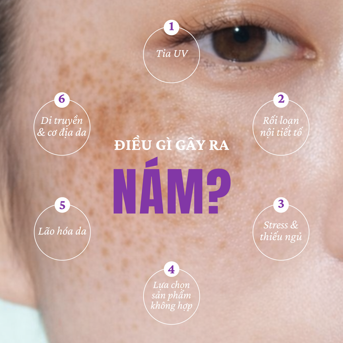 cách trị nám gò má tại nhà​