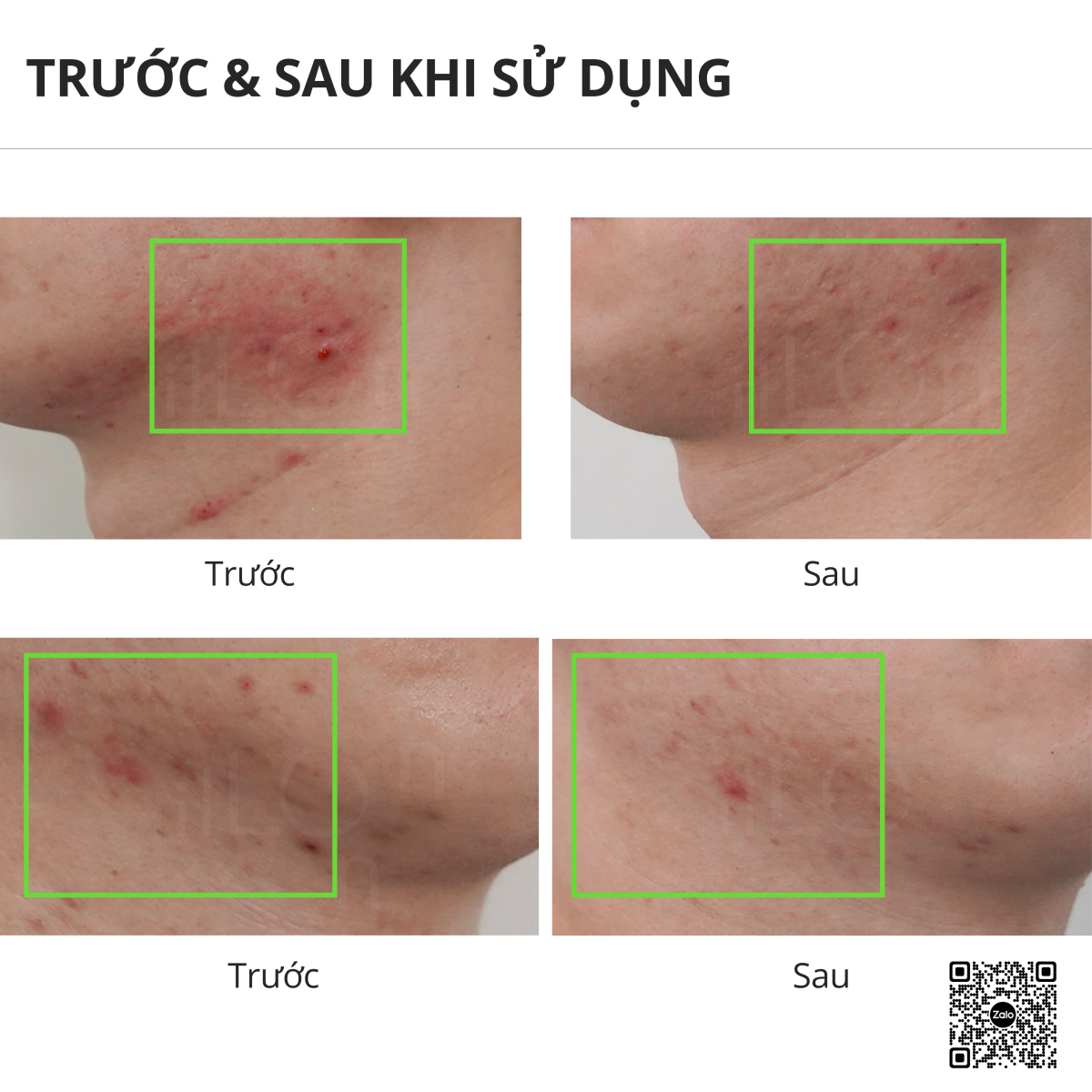 điều trị mụn